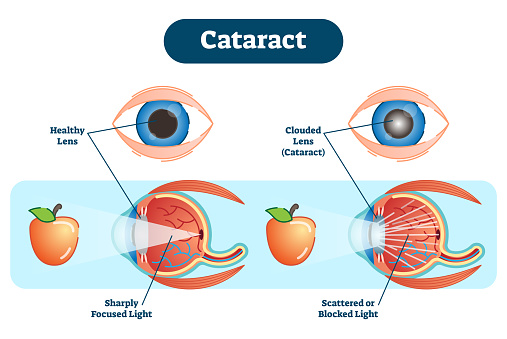 cataract illustration